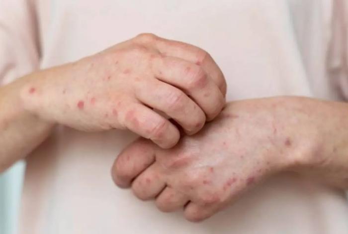 Confirma Michoacán primeros casos de sarampión ¿dónde?