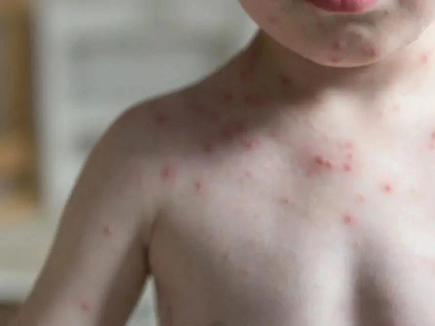 Confirman primeros tres casos de sarampión en Michoacán