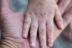 En Michoacán se reporta un cuarto caso de sarampión en Maravatío