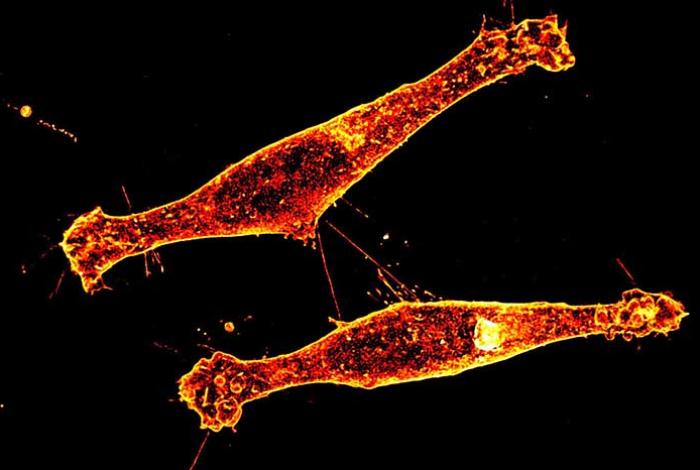 Hallan una nueva vía para intentar frenar la enfermedad de Huntington