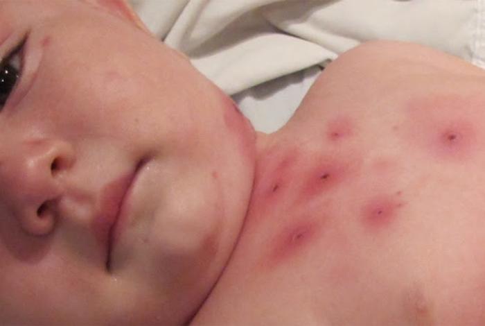 Importados y sin vacunación previa, pacientes con sarampión en Michoacán