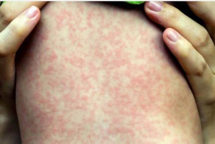 Michoacán reporta cuarto caso de sarampión en Maravatío