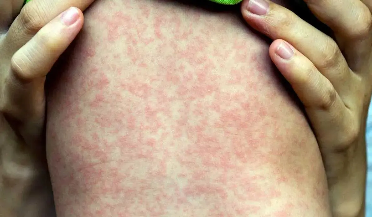 OPS lanza alerta por sarampión; México concentra gran parte de los casos en las Américas