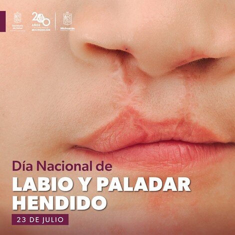 #Salud | SSM previene y atiende el labio y paladar hendido