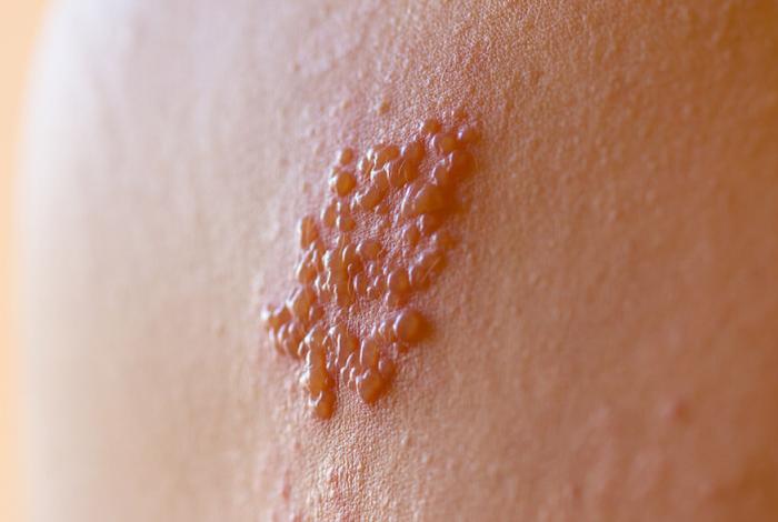 ¿Tuviste varicela? Cuidado con el herpes zóster